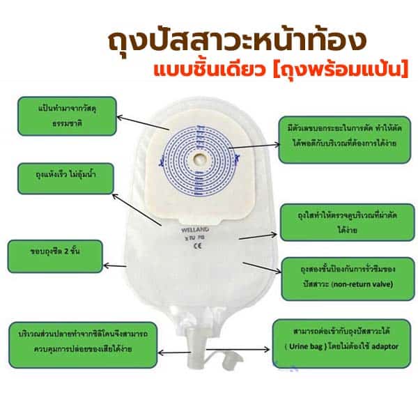 ถุงปัสสาวะติดหน้าท้อง